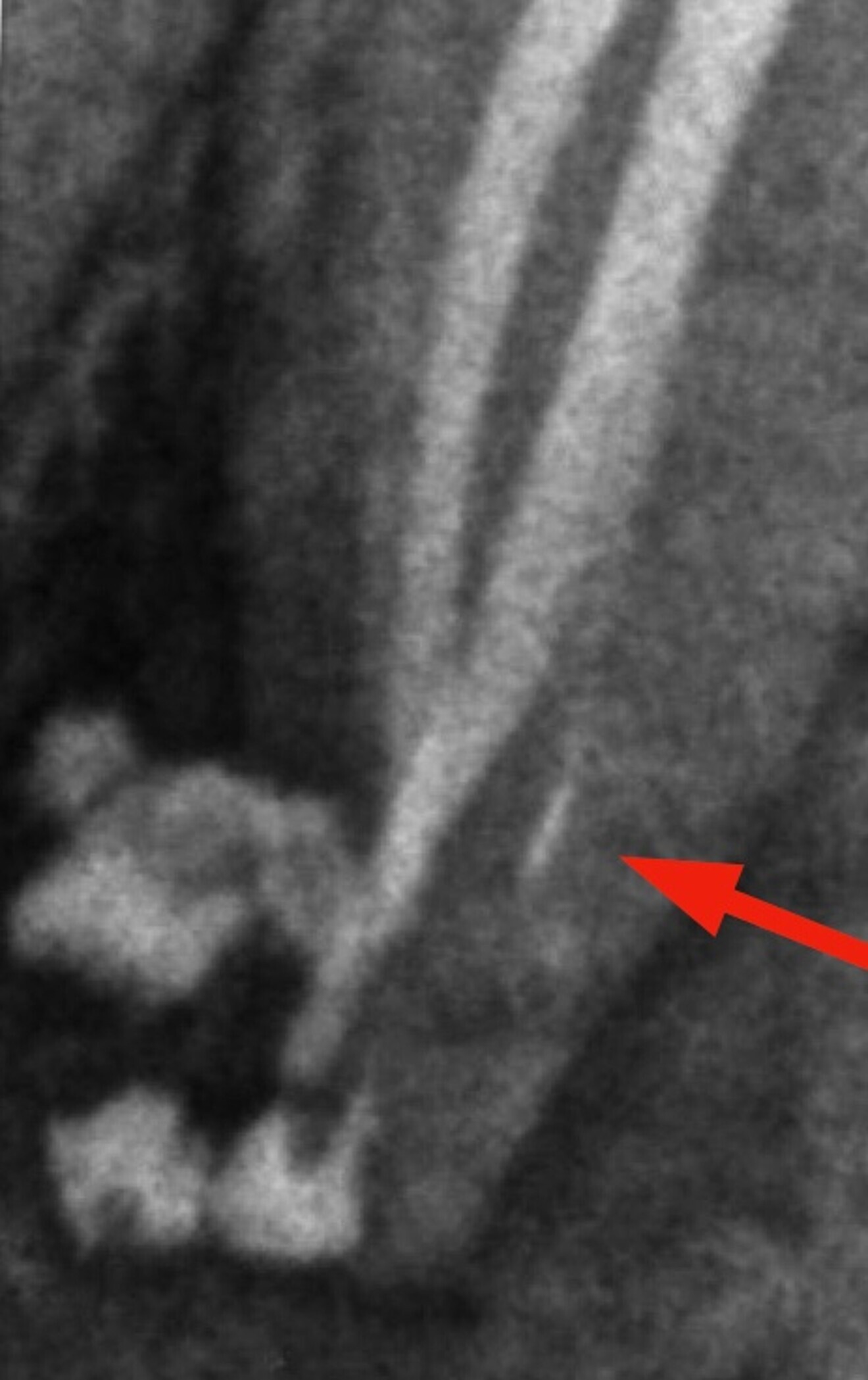 Fig 5. Lateral exit