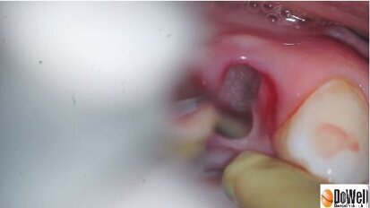 Vista and Access Piezo Surgery Video