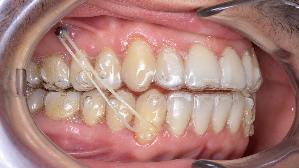 Mandibular occlusal plane management with micro-screws to correct an edge-to-edge incisal relationship