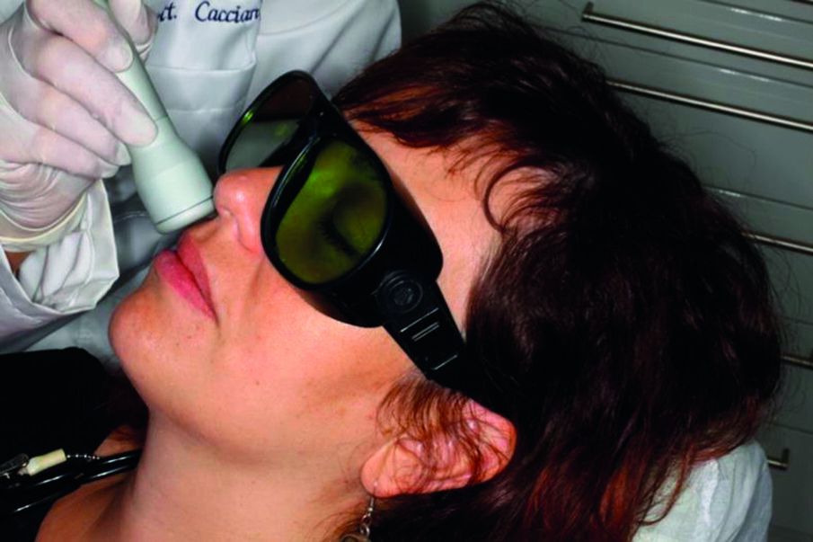  Fig. 1 - Foto-bio-modulazione (biostimolazione) laser esterna con il manipolo a onda piana (laser a diodo 980 nm). Il fascio è direzionato attraverso la fibra ottica posizionandolo su tutti i settori interessati dal movimento ortodontico. Il trattamento dura 300 secondi.