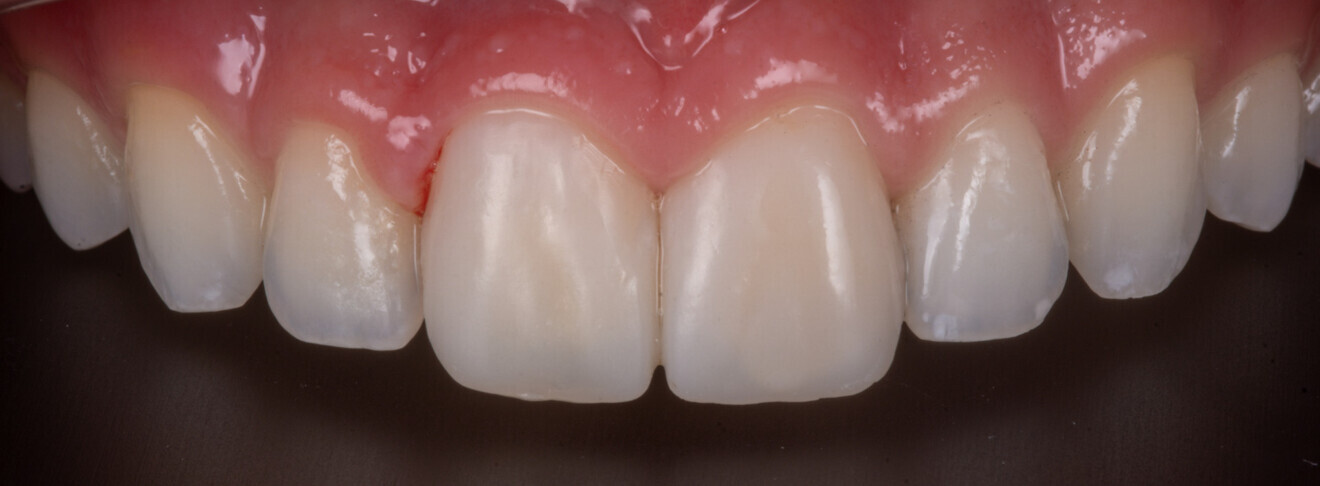 Fig. 25 : Facettes mono-teintes sur 11 et 21.