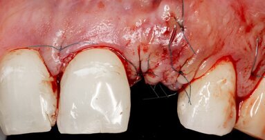 Penicillin-allergic patients may present a higher risk of dental implant failure, study suggests