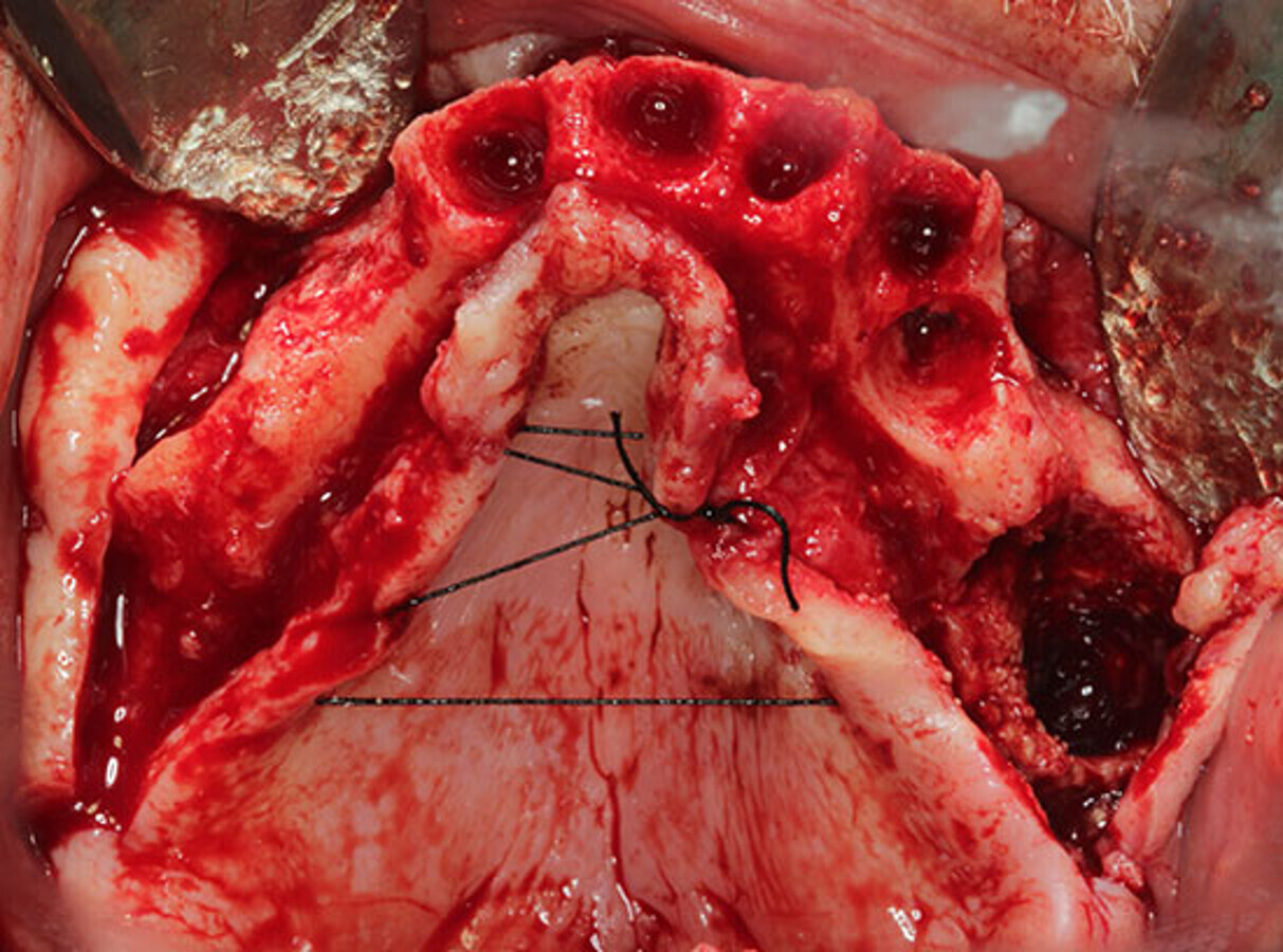 Fig. 11. Imagen oclusal del colgajo a espesor completo elevado y de la comunicaciÃ³n orosinusal. 