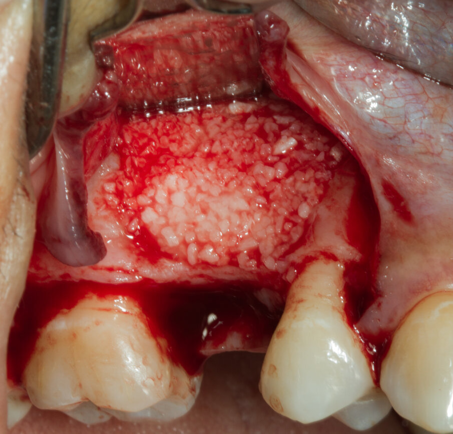 Fig. 8 - Gen-Os stabilizzato con Tisseel compattato nel difetto osseo.