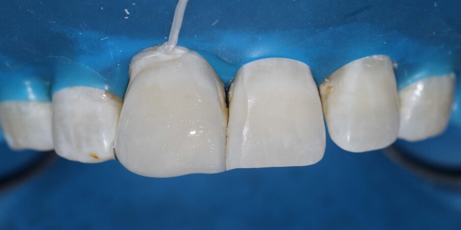 Fig 10: Composite Build up completed and cured under Glycerin gel