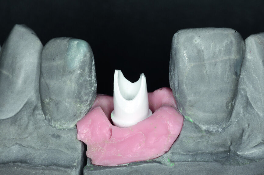 Fig. 9a: The definitive zirconia crown was fixed to the customised abutment made of alumina-toughened zirconia.
