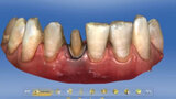 Fig. 7. También para la preparación de la corona completa en el diente 41 se estableció digitalmente el límite de la preparación.