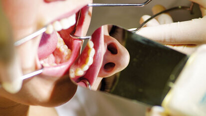 Einsatz eines beschlagfreien Intraoralspiegelsystems