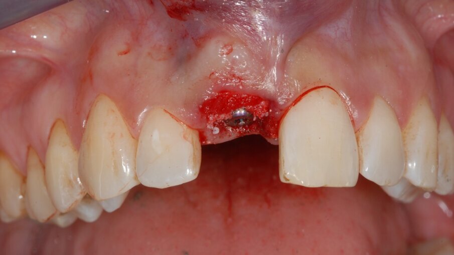 Fig. 3 - Appena inserito l’impianto il gap tra impianto e osso alveolare è stato zeppato con del biomateriale e tra i tessuti molli e il piatto osseo buccale è stata inserita una matrice dermica.