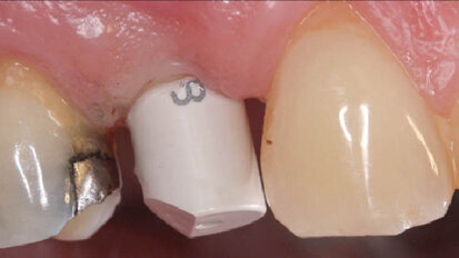 Zařízení na digitální otiskování 3Shape TRIOS® nyní i se skenováním implantátů