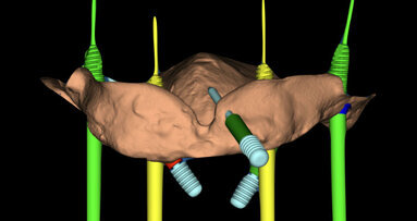 Mantenimento igienico delle protesi full-arch a supporto implantare con abutment a basso profilo