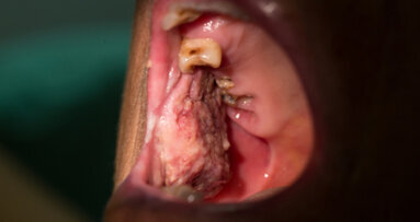 Oral cancers may go undetected during COVID-19 crisis