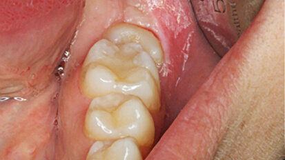 Tratamiento de segundo y tercer molar inferior “enclavados”