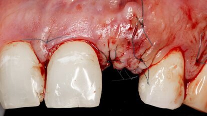 Penicillin-allergic patients may present a higher risk of dental implant failure, study suggests