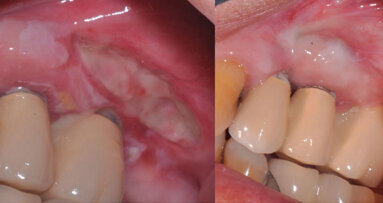 Study: Graft can help improve gums’ support for existing implants