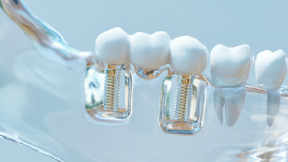 Titanium particles linked to antibiotic failure in peri-implantitis