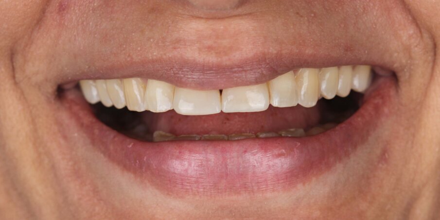 Fig 17. Final smile