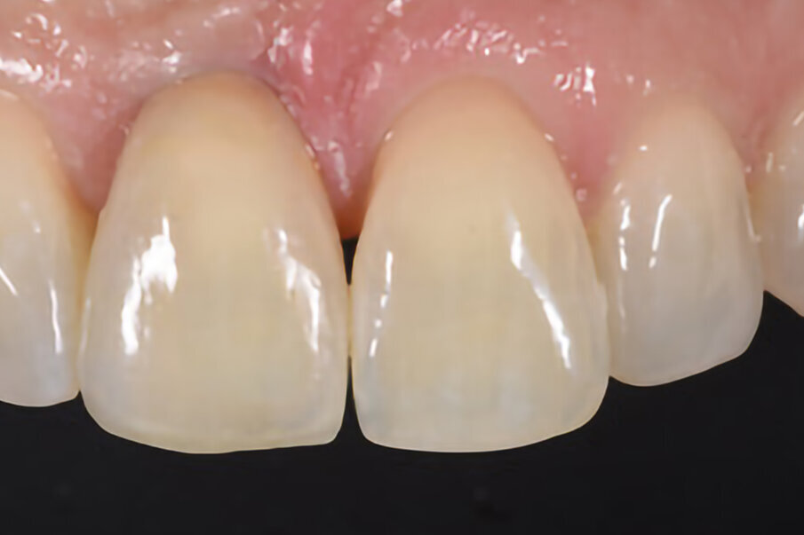 Fig. 14b: The anterior crown restored.