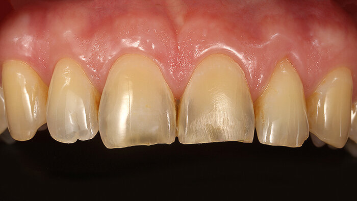 Fig. 1: Initial situation: Erosion and abrasion led to a shortened incisor and the loss of the morphology of teeth 11 and 21.