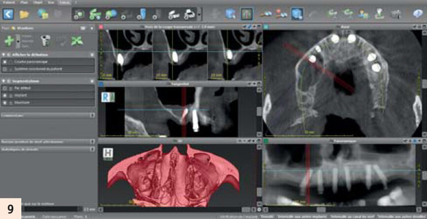 Vérification 3D après chirurgie sur CodiagnostiX, situation très proche de la planification initiale.