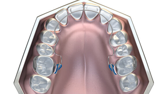 How to avoid extractions when treating malocclusions using MRC’s Bent Wire System (BWS) and Trainer System for arch development