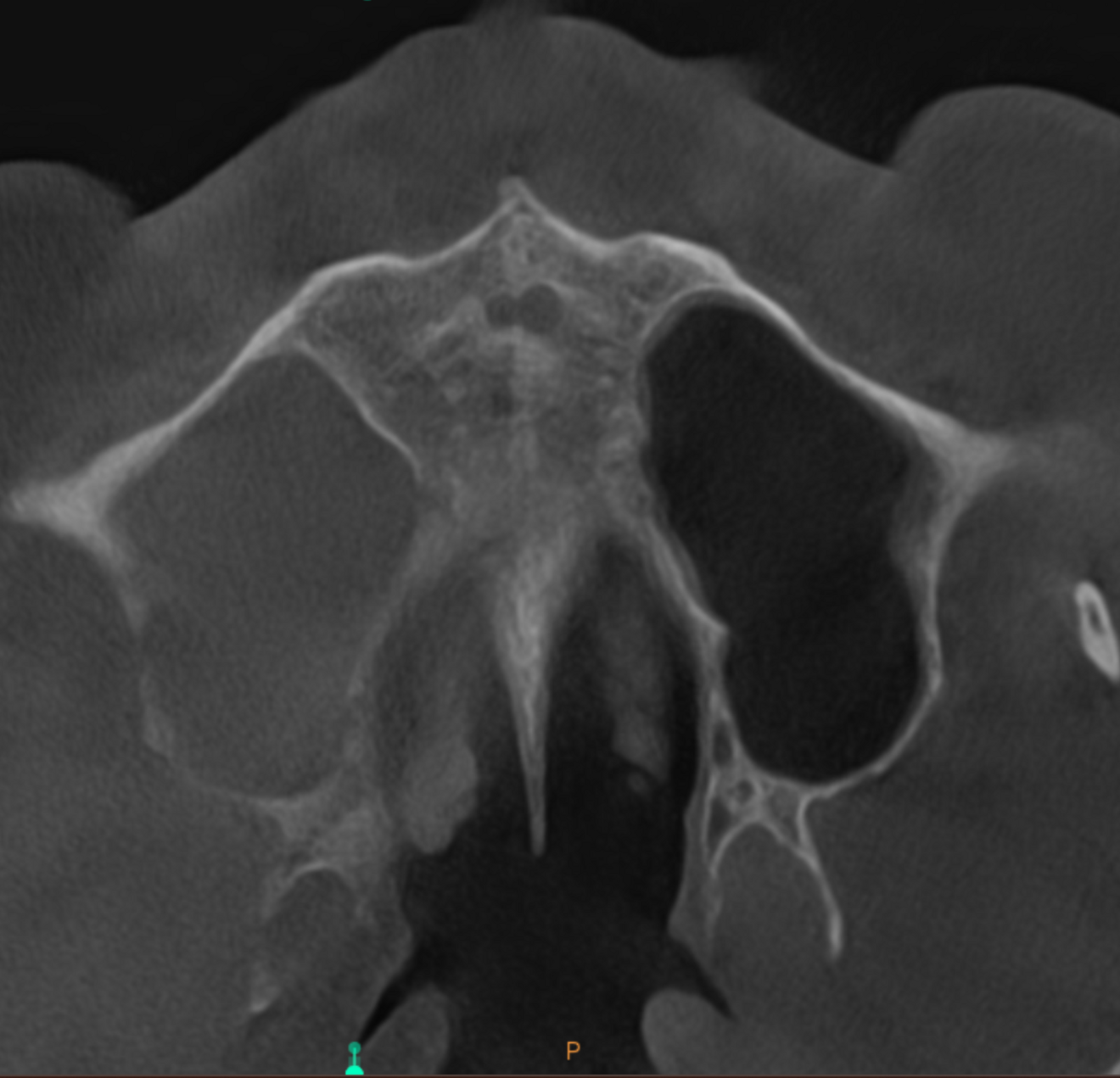 Fig. 5c: Mid-level transversal cross-section of the maxilla showing full involvement of the maxillary sinus.