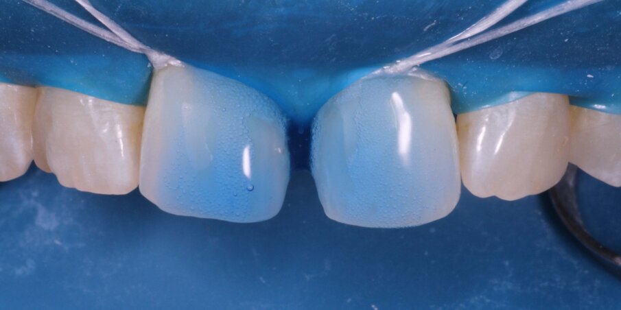 Fig 3. Isolation, removal of residual composite and Etch with 37% Phosporic Acid