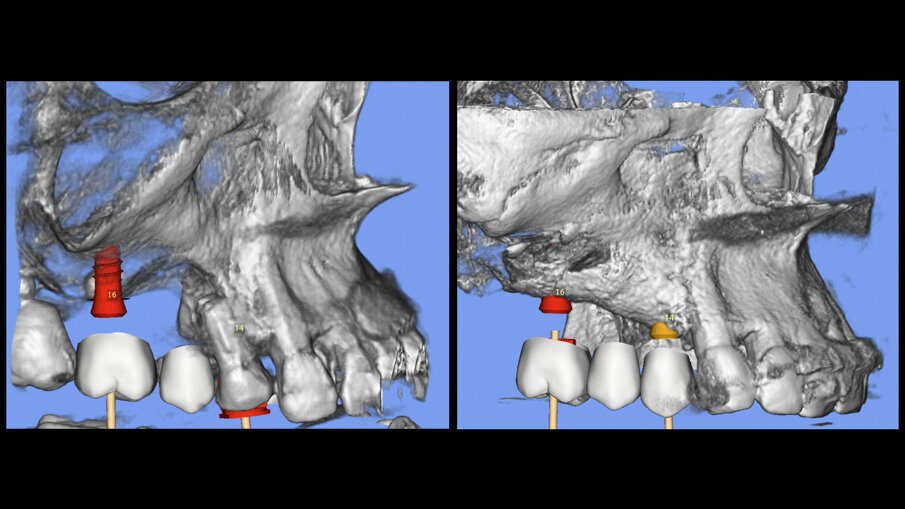 Fig. 9 - CBCT al baseline e a 6 mesi - ricostruzione 3D.
