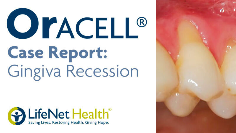 Patient with severe gum recession treated with Oracell.