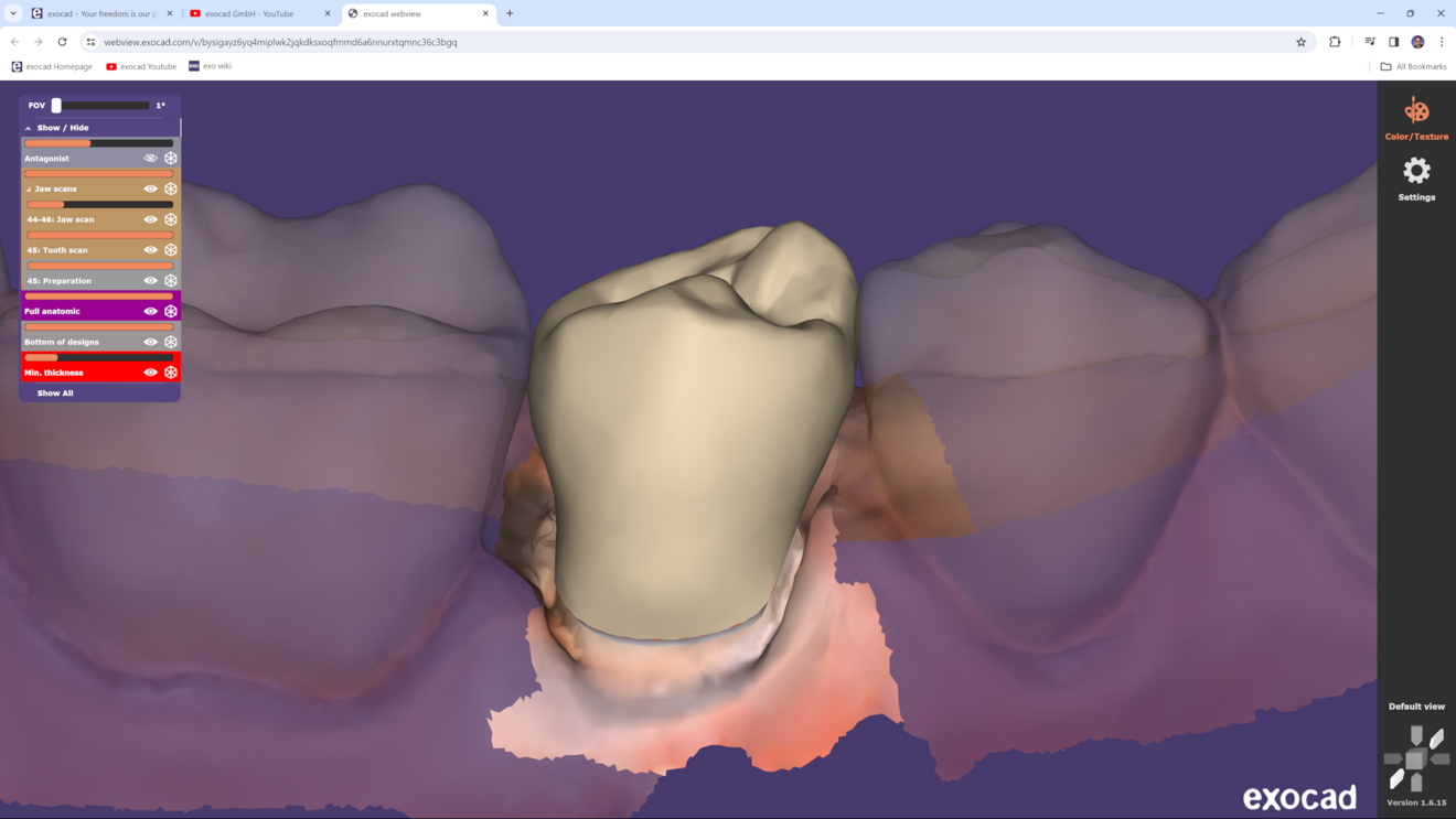 Fig. 4: The exocad webview enables users to share a design preview, including the modified preparation margin, with a practitioner prior to consultation. The preview can be opened free of charge in any standard browser on a PC or smartphone.