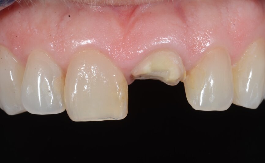 Fig. 2: Initial situation, intra-oral view.