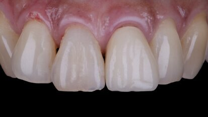 Immediate implant placement in the aesthetic zone: Two-year follow-up