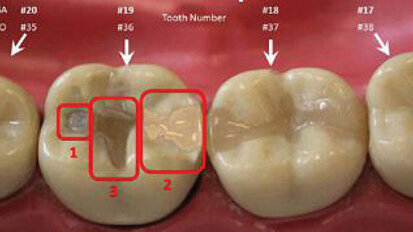 Protocol for forensic dental data now same as for DNA and fingerprinting
