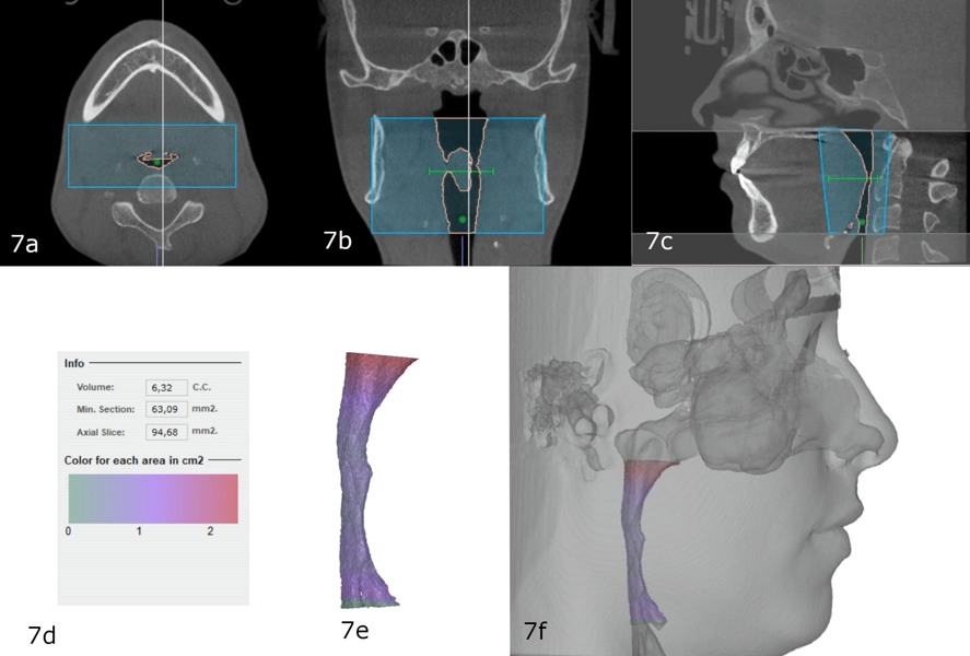 Figs. 7a–f: Pretreatment airway volume.