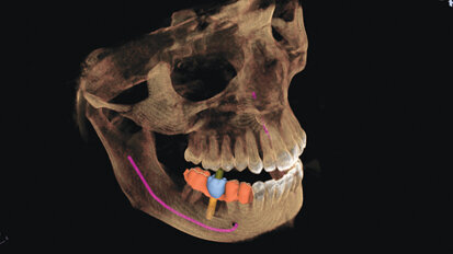 CEREC meets GALILEOS: Implant planning reaches a new level