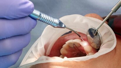 Studie: Laserlicht löst Kronen, Veneers und Brackets