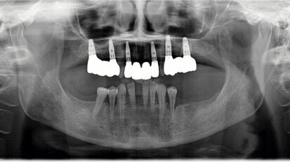 Augmentacija dentinskim graftom u gornjoj čeljusti