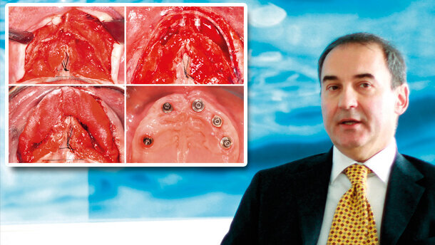 Alla ricerca della combinazione ideale tra capacità di creare spazio e ridotta invasività