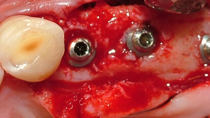 Riabilitazione implanto-protesica in un caso di grave atrofia ossea al mascellare superiore risolto mediante l'utilizzo di short implants
