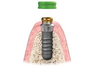 SternSnap Overdenture Implant Abutment System