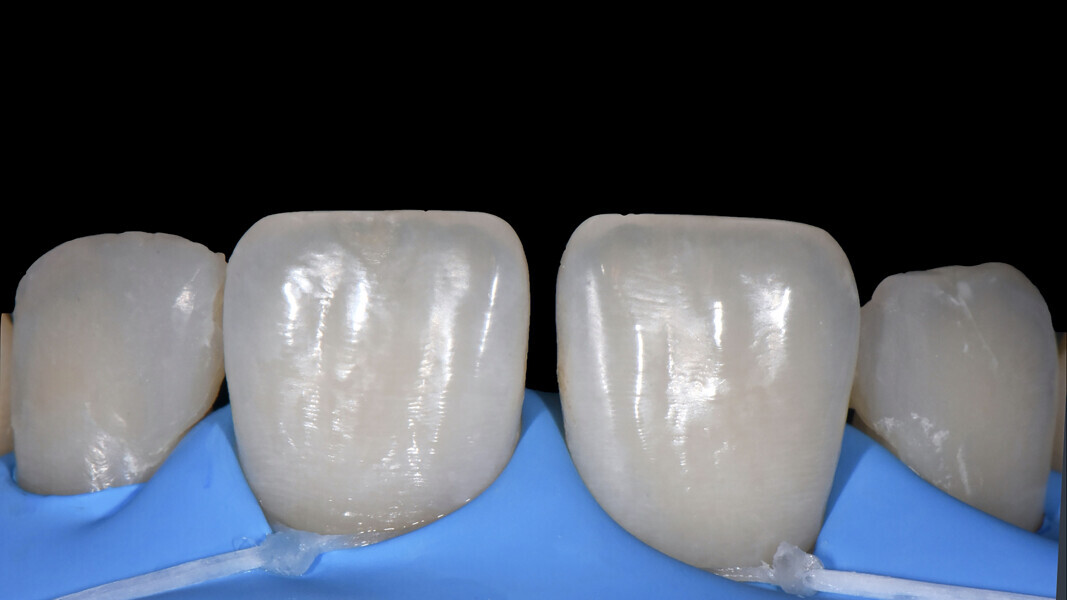 Fig. 4: Dental dam in situ.