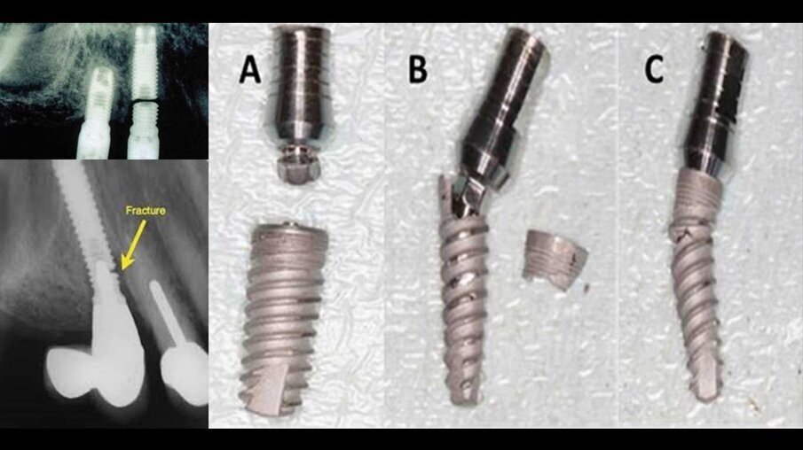 Fig. 8_Esempi di frattura implantare.