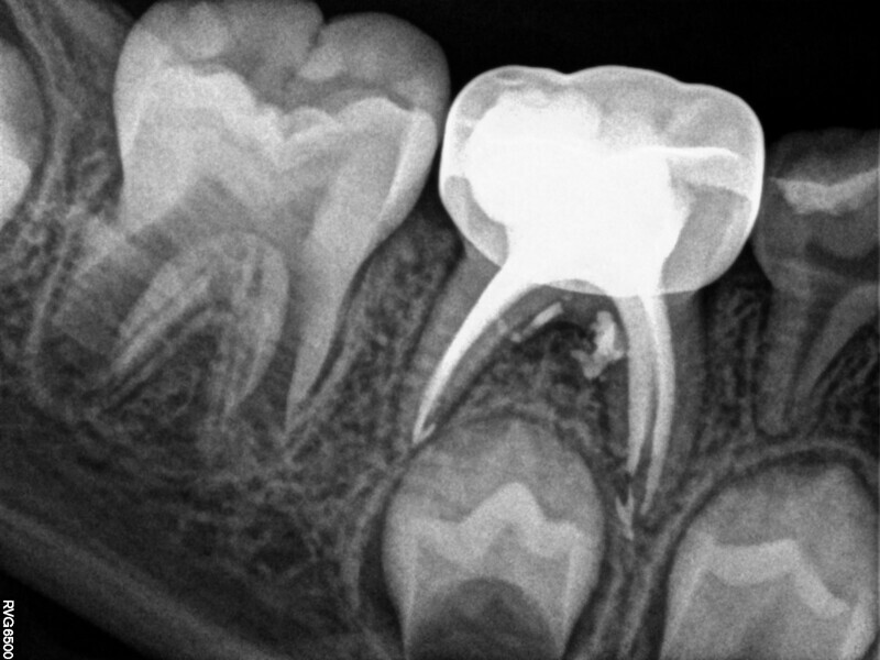 Fig. 4 : Contrôle à 15 mois montrant une apposition osseuse dans la zone de la furcation.