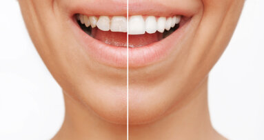 Adhesives influence colour stability of composite veneers