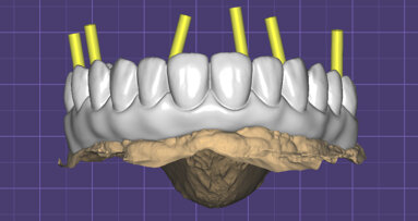 Efficient production of a hybrid implant-supported full-arch prosthesis