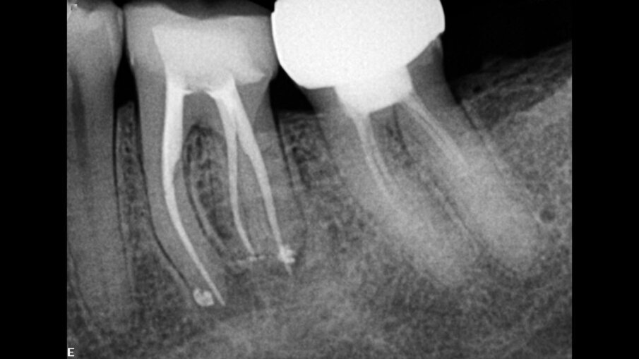Fig. 6: One-year follow-up radiograph showing complete healing.