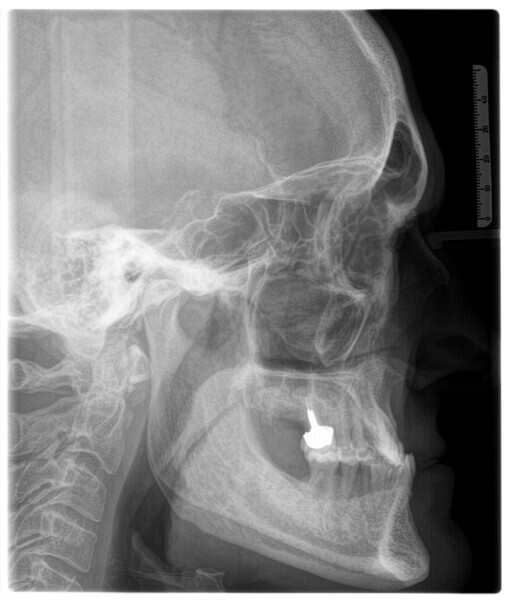 Figs. 13a & b: Initial lateral cephalometric radiograph and dental panoramic tomogram.