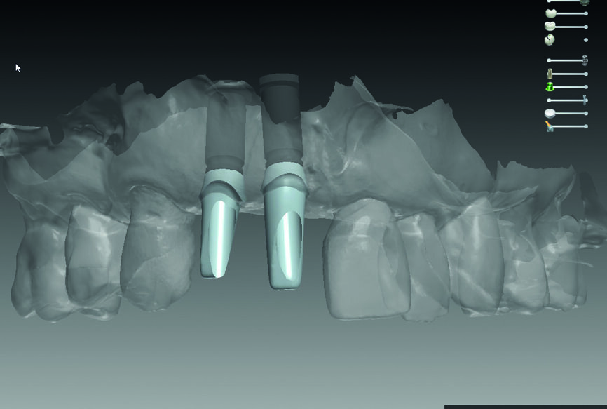 Fig. 15 : Contrôle de la hauteur transgingivale des piliers anatomiques pendant le design.