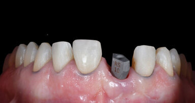 De Invisalign Smile Architect-software maakt het combineren van orthodontische en restauratieve behandelplannen mogelijk