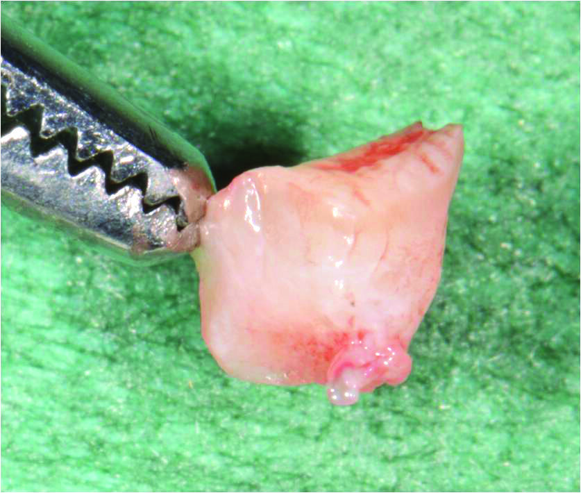 Fig. 4_Prelievo di connettivo dalla sella edentula.